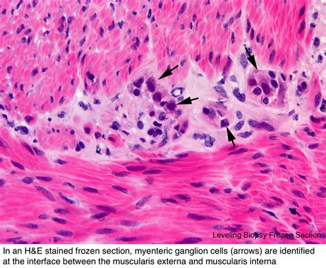 Pathology Outlines - Hirschsprung disease