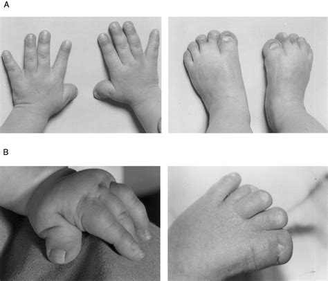 Medical Pictures Info – Achondroplasia