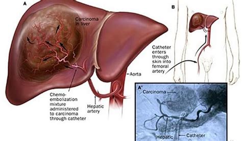 Chemoembolization in the Management of Liver Tumours | Dr Abhilash