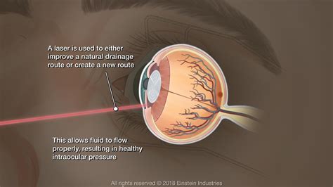 Glaucoma Treatment