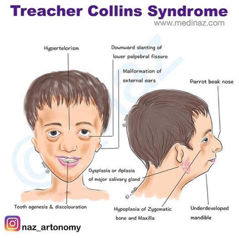 síndrome de treacher collins nhs | Personalitytipsonline