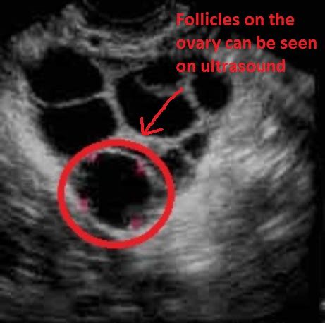 IVF (In Vitro Fertilisation) Cycles - Fertility Solutions