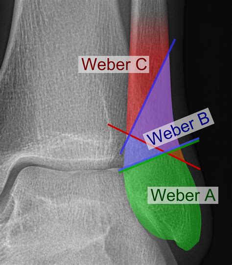 Weber Ankle Fracture - Classification | Treatment | Surgery