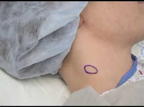 Lymph Node Biopsy - YouTube