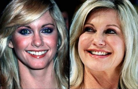 Olivia Newton John Plastic Surgery Before And After Pictures