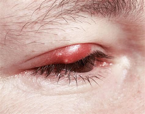 What are the Different Eye Infection Symptoms? (with pictures)
