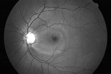 Nerve Fiber Layer Defects Imaging in Glaucoma | IntechOpen