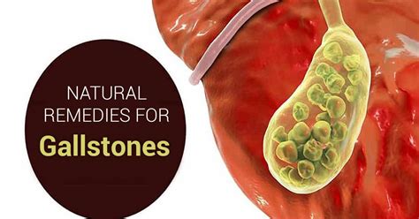 Home Remedies for Gallstones - Gotta Do The Right Thing