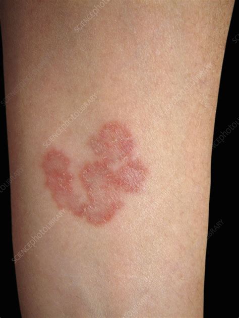 Dermatophyte fungal infection - Stock Image - C045/9546 - Science Photo Library