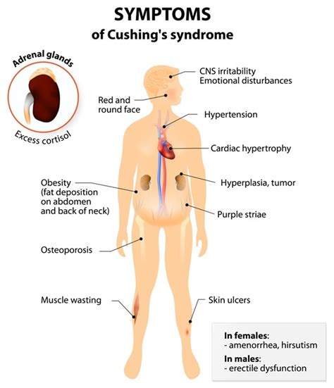 Cushing's Syndrome Signs and Symptoms