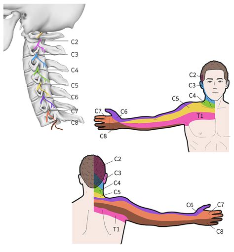How To Fix A Pinched Nerve In Your Neck Cervical Radi - vrogue.co
