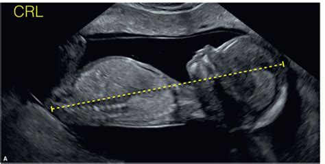 The Detailed First Trimester Ultrasound Examination | Radiology Key