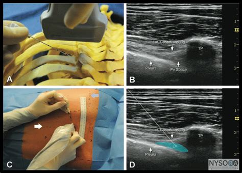 Thoracic Paravertebral Block - NYSORA The New York School of Regional ...