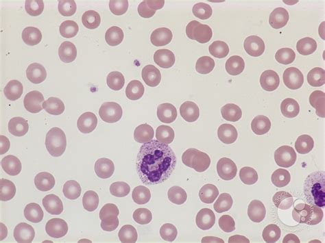 Normochromic normocytic anemia - 1.