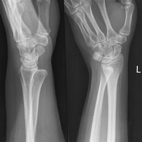 Distal Radioulnar Joint