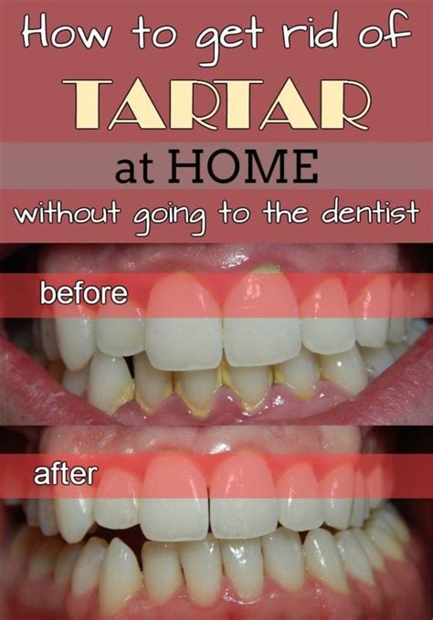 How to get rid of tartar at home without going to the dentist | Healthy Mom