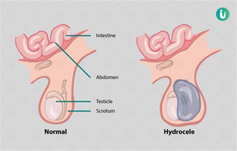 Hydrocele surgery: Procedure, Purpose, Results, Cost, Price ...