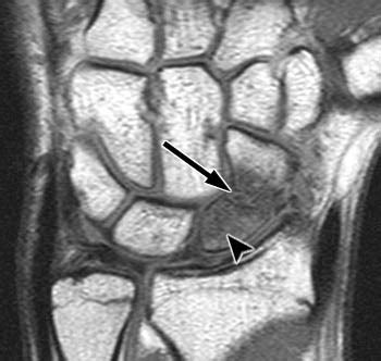 Scaphoid Fracture | Radsource