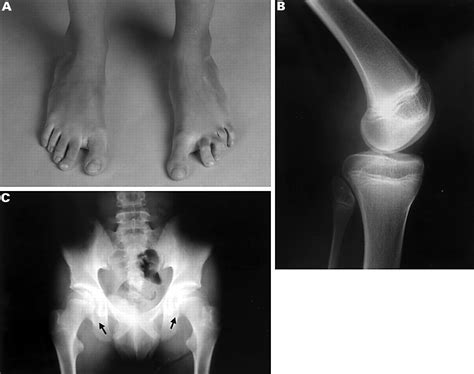 Nail - Patella Syndrome is not