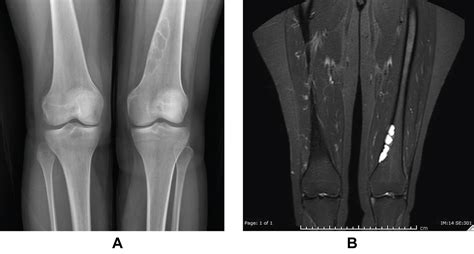 Evaluation of the Patterns of Benign Bone Tumors and Tumor-like Lesions: A Retrospective Survey