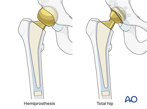 Hemiarthroplasty For Femoral Neck And Head Fractures With, 57% OFF