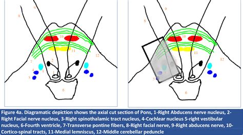 Figure 4 from A rare case of lateral pontine syndrome-Marie Foix syndrome | Semantic Scholar