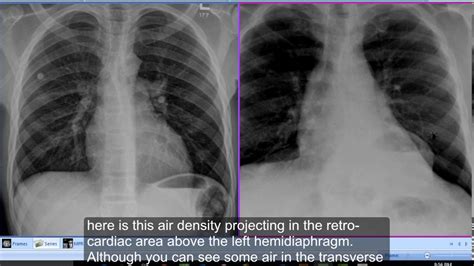 Chest x-ray, Hiatus Hernia - YouTube