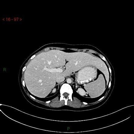 Beaver tail liver (normal variant) | Radiology Case | Radiopaedia.org | Beaver tails, Hodgkins ...