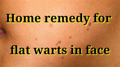 Flat Warts Warts Treatment