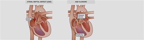 DEVICE CLOSURE OF ASD / VSD | MARIAN