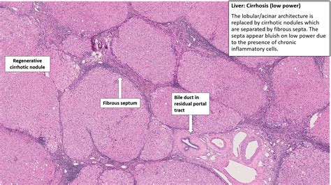 Liver with Oesophagus – Cirrhosis with Oesophageal Varices – NUS Pathweb :: NUS Pathweb