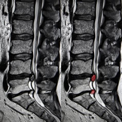 Lumbar Spine Mri Herniation