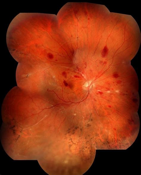 Disease of Eales - Retina Image Bank