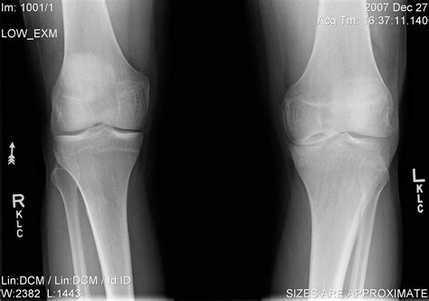 Osteochondritis Dissecans Knee