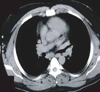 37 year old male with new mediastinal and hilar lymphadenopathy. | Download Scientific Diagram