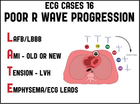 ECG Cases 16: poor R-wave progression - LATE mnemonic | ECG Cases