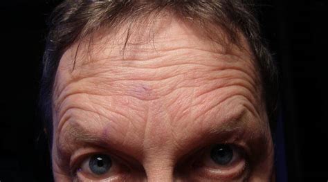 Deep forehead wrinkles may signal heart disease risk | Lifestyle News ...