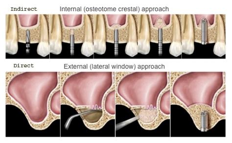 Sinus lift Sometimes Needed with Posterior Implants