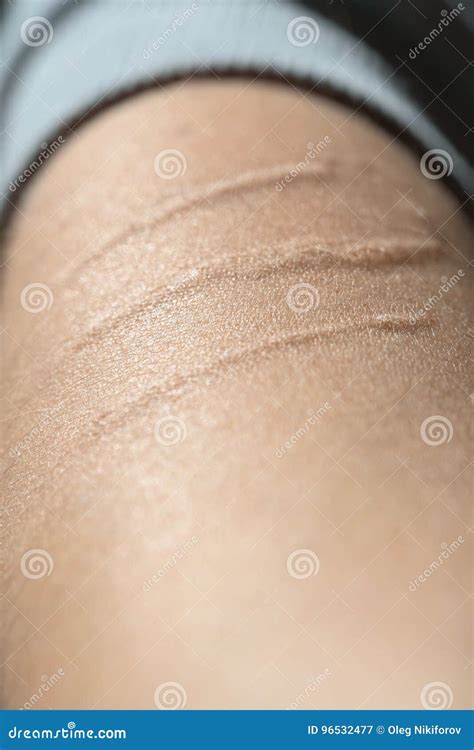 Scar on hand stock image. Image of distress, pain, scabbing - 96532477