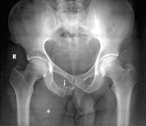 Intraosseous schwannoma of inferior pubic ramus – A rare benign osseous neoplasm - Indian ...