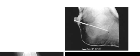 Fig A. Preoperative X-ray shows tongue type intraarticular calcaneal ...