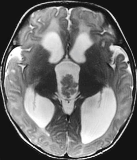 Gliosis Mri - IMobile Cool