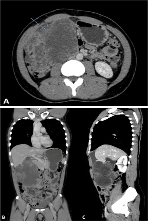 A: Computed tomography scans of the chest and the abdomen revealing a... | Download Scientific ...