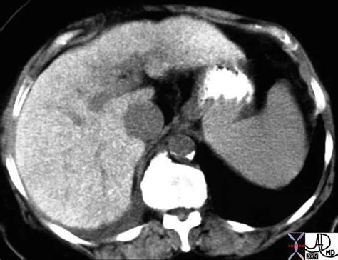 CT Density of the Spleen | Spleen