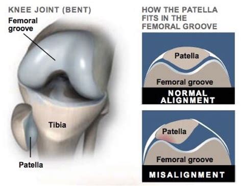 Pin on Patellar Tracking Disorder