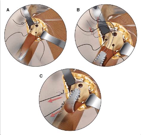 Illustrations showing the shuttling technique of the PDS suture loop... | Download Scientific ...