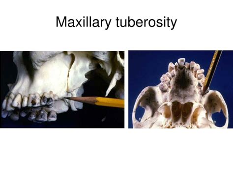 Maxillary Tuberosity Anatomy