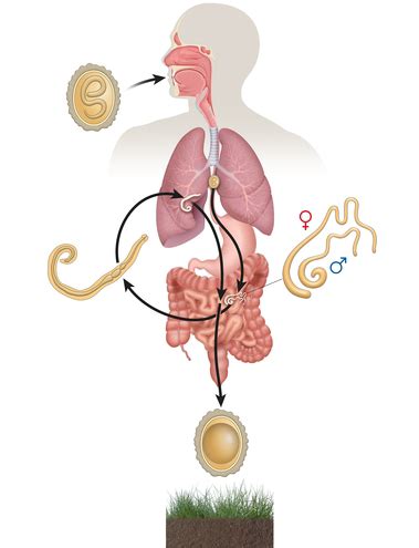 Ascariasis | Symptoms, Causes, Diagnosis & Treatment