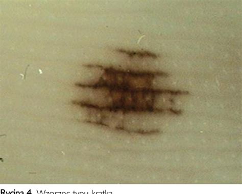 Figure 4 from The role of dermoscopy in the diagnosis of acral ...