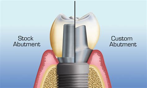 CUSTOMIZED ABUTMENT - DETEC